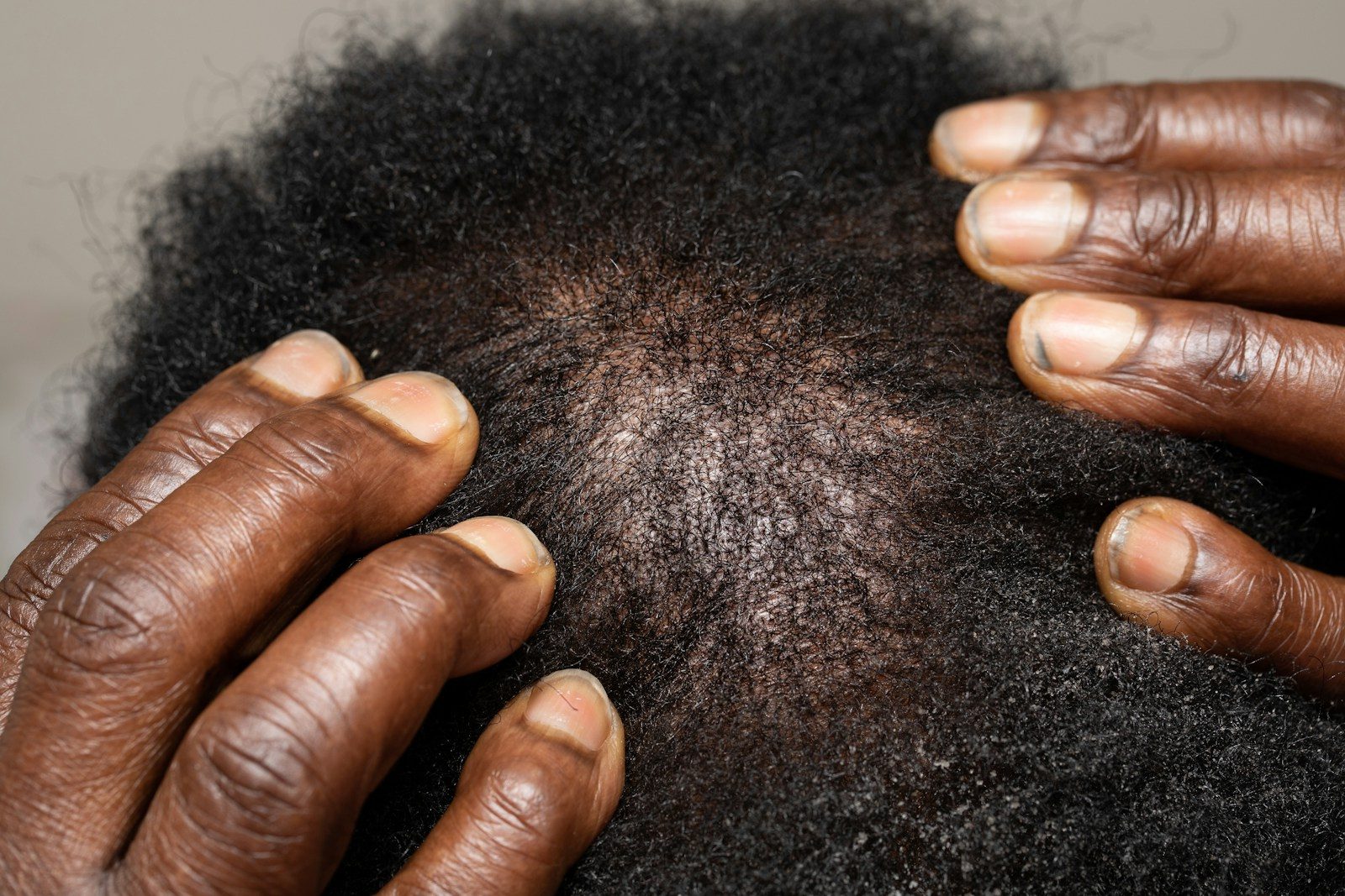 Hair Loss